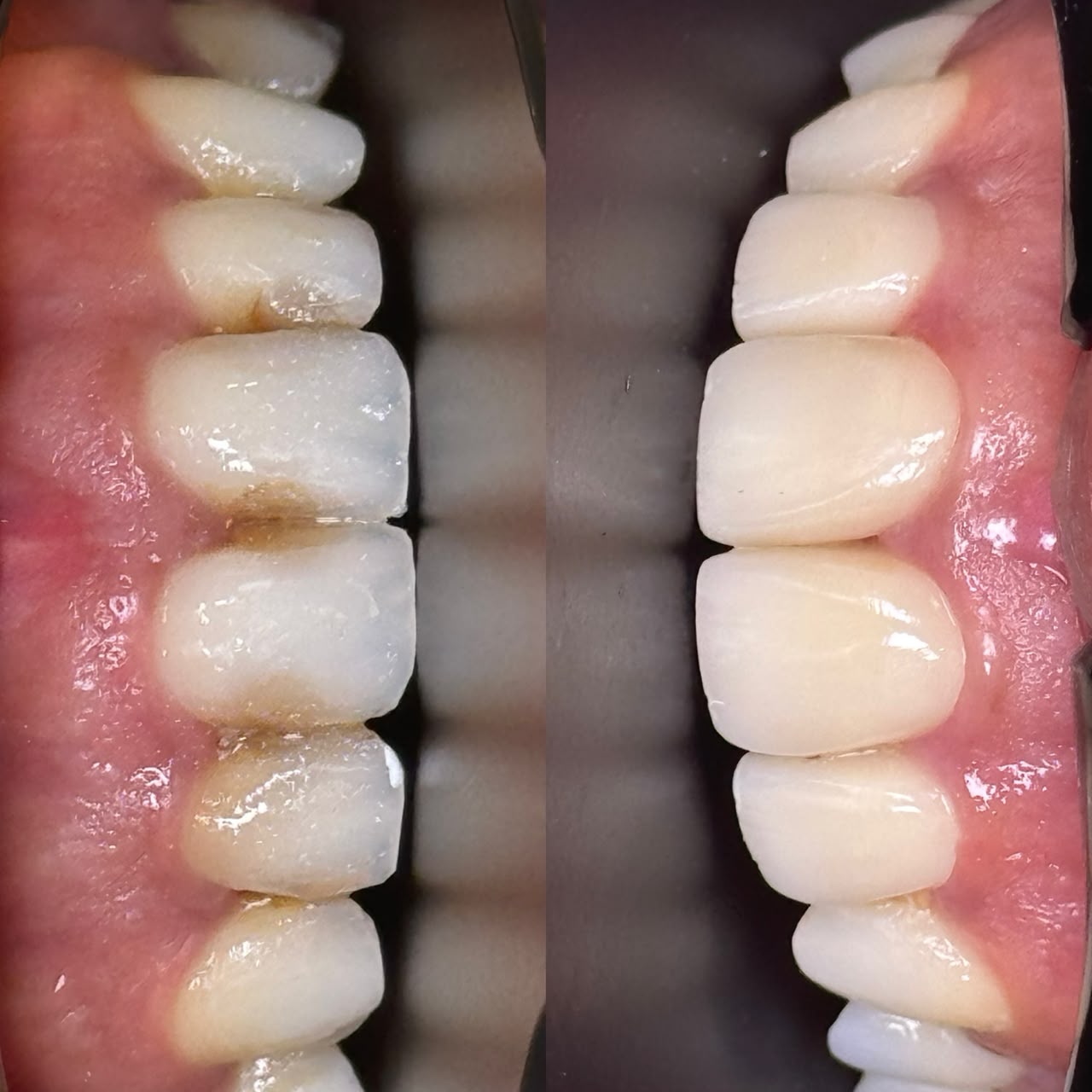 Transformation esthétique des dents antérieures avant après